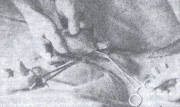 Семенной канатик с отделённым спермиопроводом при вазэктомии по способу Шипилова.