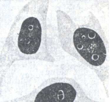 Рис. 2. Внутриядерные тельца Иоста—Дегена в нервных клетках аммонова рога при борнаской болезни.