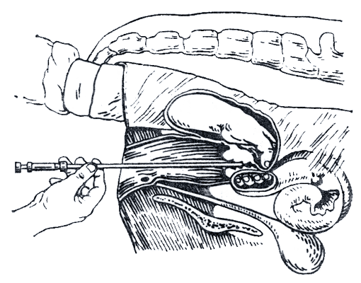 Рис 2. Введение пипетки в переднюю треть шейки матки при осеменении коровы с ректальной фиксацией шейки матки.