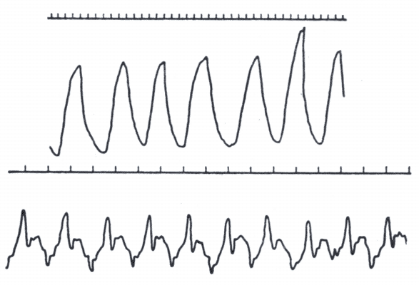 Пневмограмма здоровой лошади (верхняя кривая) и больной альвеолярной эмфиземой (нижняя кривая) (по Васильеву).