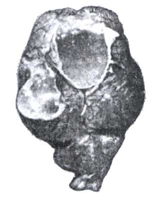 Рис. 2. Мозг овцы, поражённый Coenurus cerebralis.